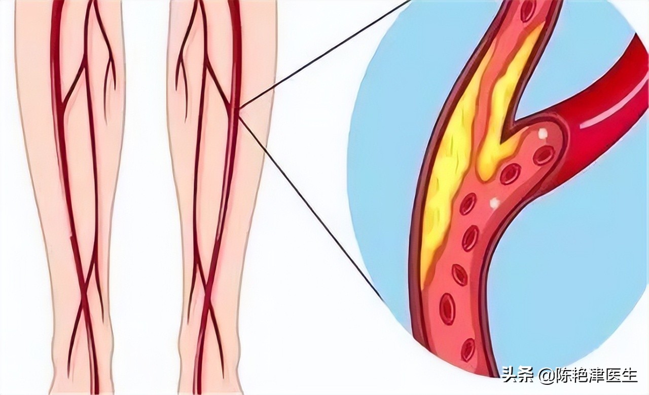 睡觉时突然腿抽筋，就是缺钙？错！还有这3个原因，别轻易忽视