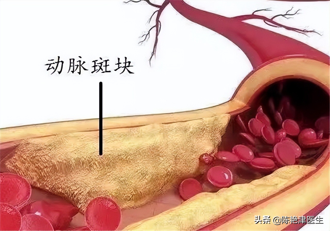 睡觉时突然腿抽筋，就是缺钙？错！还有这3个原因，别轻易忽视